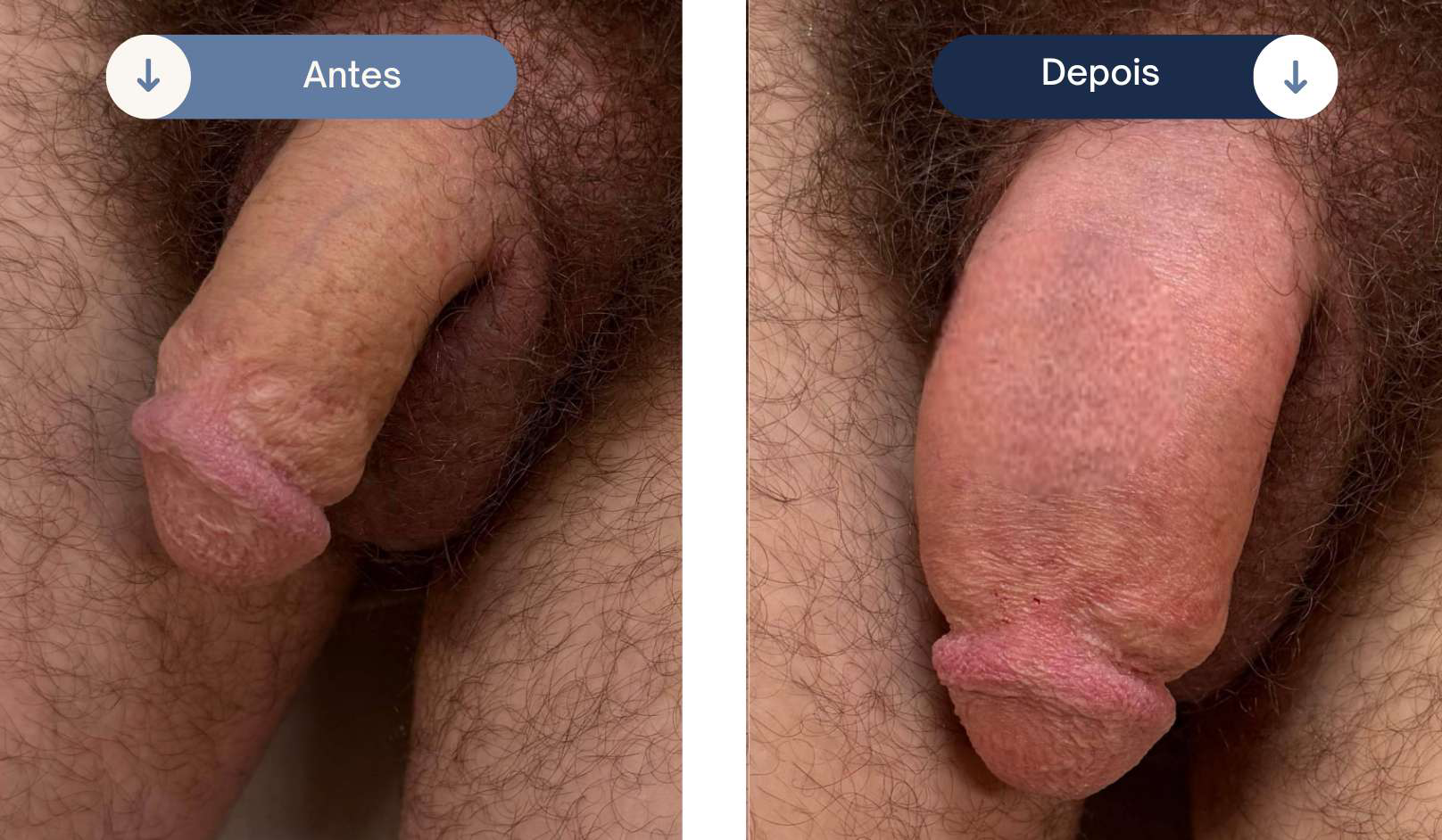 Caso clínico de preenchimento peniano com ácido hialurônico número 3 — antes e depois