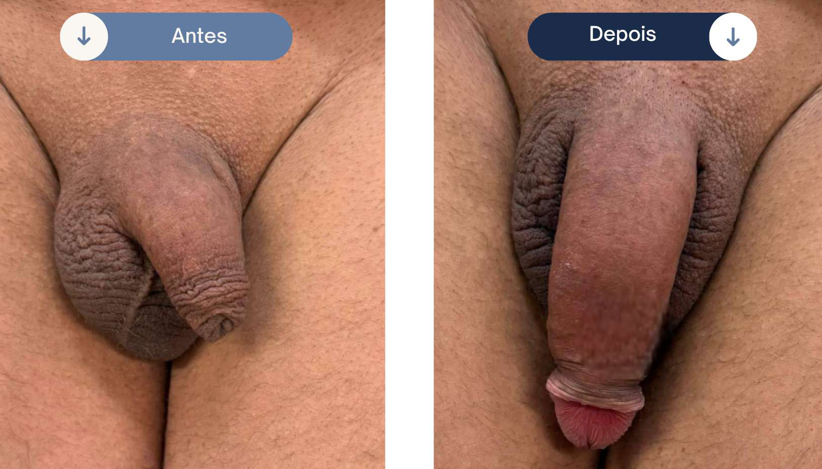 Caso clínico de preenchimento peniano número 4 — antes e depois
