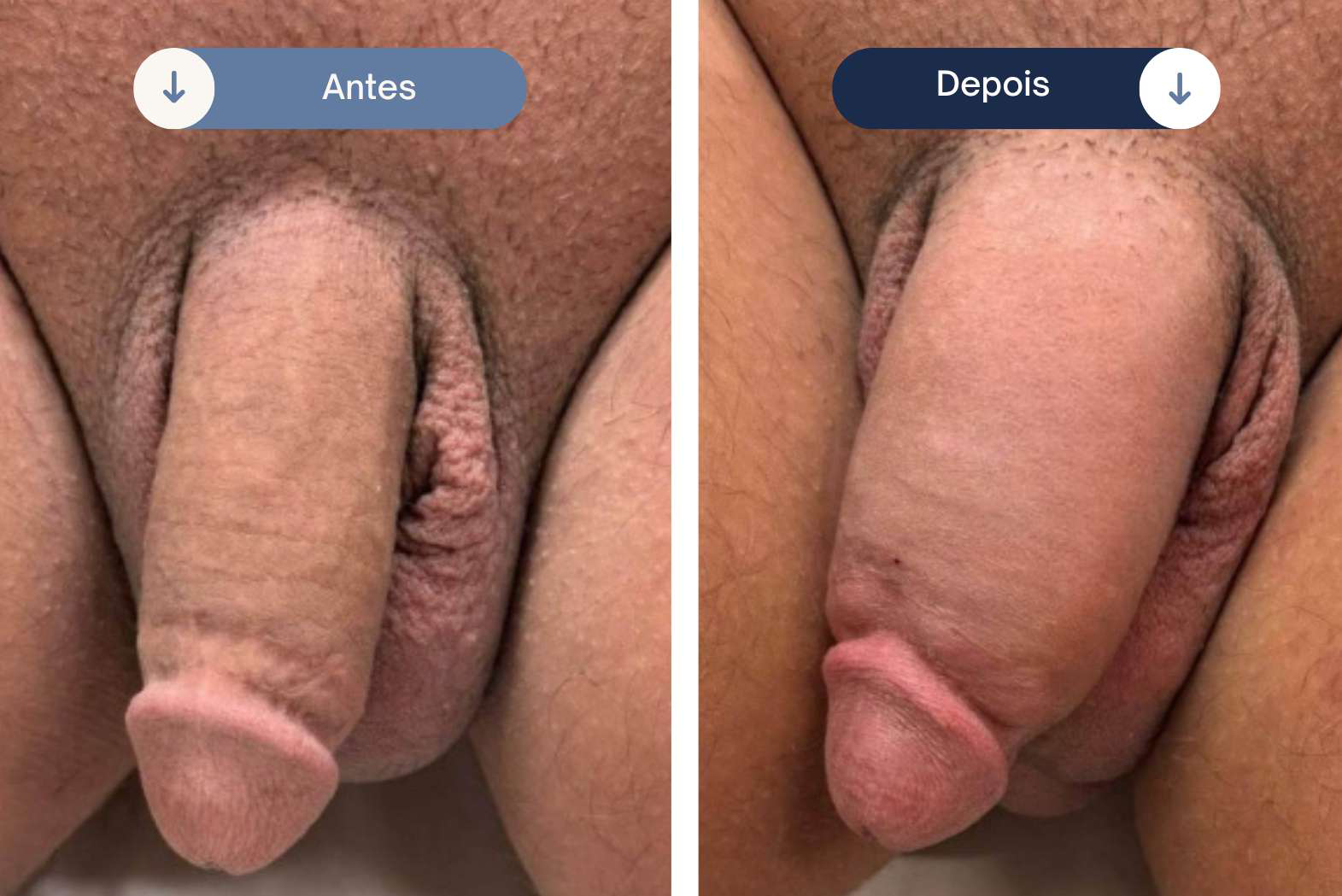 Caso clínico de preenchimento peniano número 5 — antes e depois