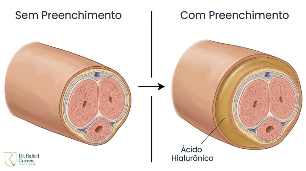 Cuidados pós-procedimento de preenchimento peniano