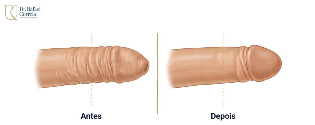 Tratamento da fimose realizado por médico urologista especialista em saúde masculina.