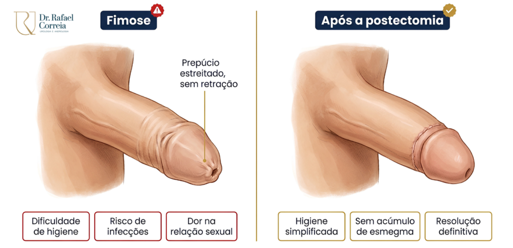 Cirurgia de fimose com técnica segura realizada em Brasília.